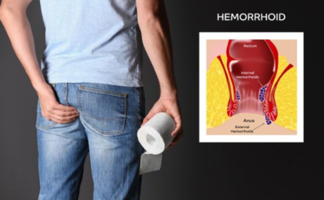 Causes and Symptom of Bleeding Hemorrhoids and top Treatment