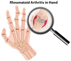 Rheumatoid Arthritis